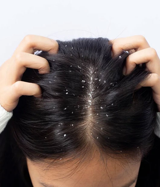 Dandruff & Scalp Detox Program