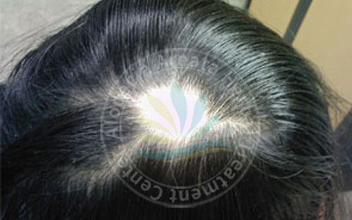 ALOPECIA AREATA