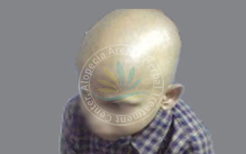 Alopecia Totalis 1