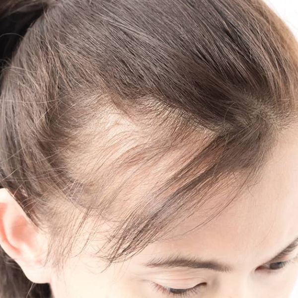 Female Hair Loss