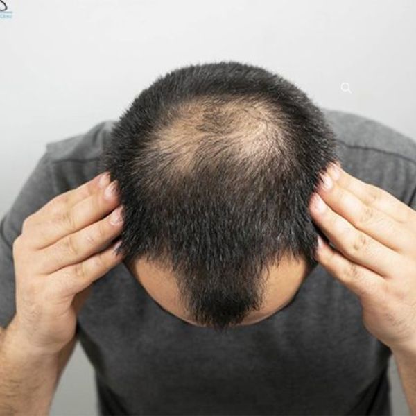 Male Hair Loss