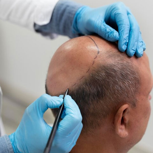 Androgenic Alopecia