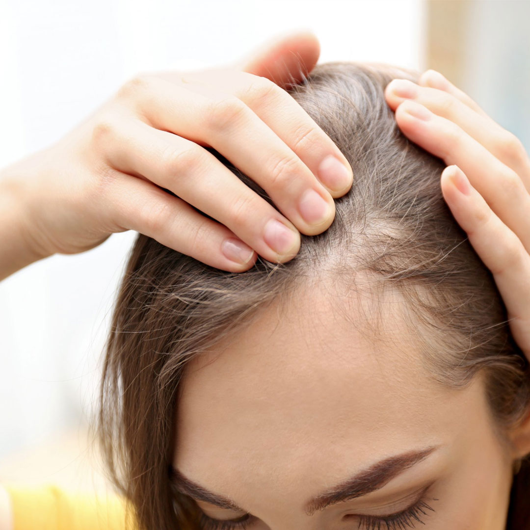 What is Alopecia Areata?